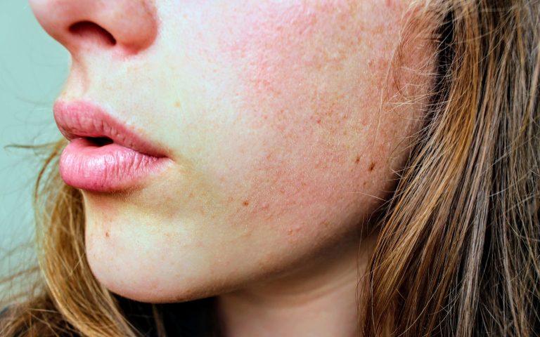 Zadbaj o suchą i wrażliwą skórę – przyczyny i pielęgnacja cery atopowej